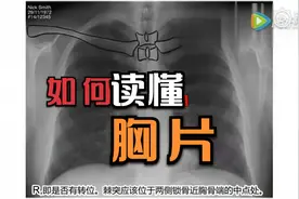 这个视频教你如何阅读胸片，5分钟学会！视频封面
