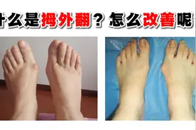 什么是拇外翻？怎么改善呢？视频封面