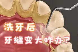 为什么洗牙后牙齿酸软?牙缝也变大了?牙齿更容易筛食物了怎么办呢视频封面