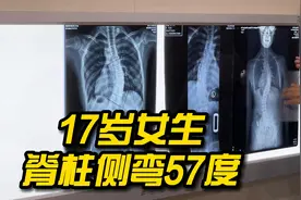 17岁女生脊柱侧弯57度，家长担心孩子过早手术影响身高视频封面