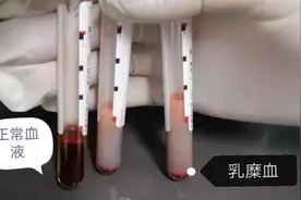 长沙73岁奶奶血脂高于常人15倍抽出“牛奶血”，常吃这种油导致