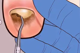 超逼真沉浸式修脚全过程，强迫症必看(短片需要 请勿模仿)视频封面
