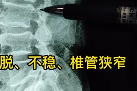 腰痛，腿痛脚麻，行走后症状加重，休息后减轻，滑脱不稳和狭窄视频封面