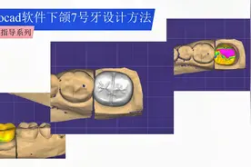 exocad 软件下颌7号牙齿设计方法视频封面