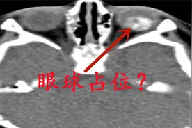 儿童患者，左眼光反射消失，眼部检查诊断什么常见疾病？医生讲解视频封面