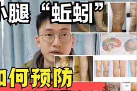 腿上“爬蚯蚓”，静脉曲张为何会发生，如何预防和减缓，医学科普视频封面