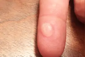 为何一些人手上会有小水泡，是身体在给你提醒吗？是在向你求助吗视频封面