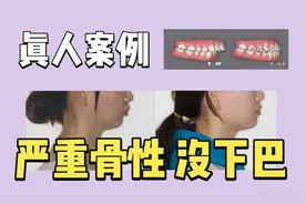 正畸日记 | 年轻女性严重深覆盖 骨性错颌没下巴 隐形矫治视频封面