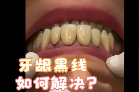 长沙牙齿修复 | 烤瓷冠牙拆除更换全瓷冠过程视频封面
