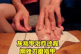 灰指甲治疗过程用锉刀磨指甲 4k纪录片视频封面