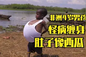 非洲4岁男孩得怪病，肚子大的像西瓜，想要上学却没有钱，好可怜视频封面