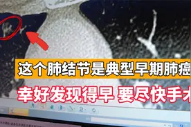 肺上长这样的结节，是典型的早期肺癌！一起来看看它的特征视频封面