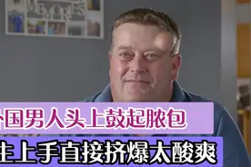 外国男人头上鼓起脓包，医生上手直接挤爆，整个过程太酸爽了视频封面