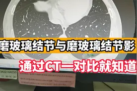 肺磨玻璃结节与磨玻璃结节影，是一样的吗？医生通过CT帮您区分视频封面