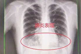 肺部x线片可以看到哪些内容，一张典型肺炎的图像表现视频封面