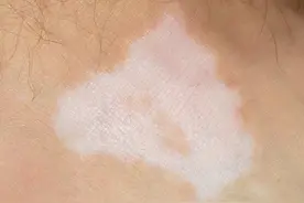 大腿上出现一块一块的小白斑，夏天都不敢穿短裤，影响特别大！视频封面