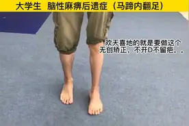脑瘫后遗症马蹄内翻足40天神奇恢复正常 不开刀无创矫正 无疤痕视频封面