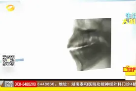 牙缝变大不能掉以轻心，因为这很可能是一个疾病的信号视频封面