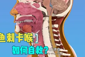 鱼刺卡喉是喝醋、吞饭还是塞大蒜？NO！专家教你三招科学自救妙招