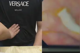 男子连续数月腹痛腹泻，检查发现肚里生虫？医生：与烹饪方式有关视频封面