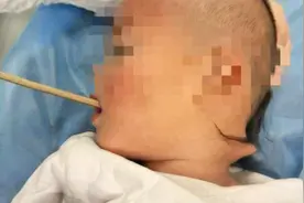 2岁幼童吃苹果被筷子贯穿喉部，从后颈戳了出来，奶奶瞬间吓傻视频封面