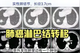 肺癌有淋巴结转移就是晚期，不能手术了？医生辟谣视频封面