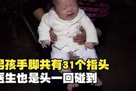 男孩手脚共有31个指头，医生也是头一回碰到，难以下手视频封面