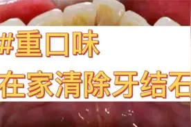 深度还原在家祛牙结石步骤！每天3分钟，成片牙石唰唰掉落！！视频封面