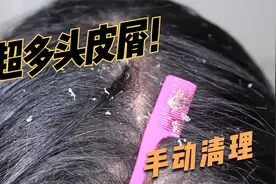 令人浑身舒爽的头皮屑清理视频封面
