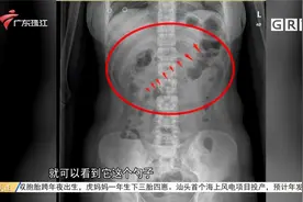 少女误吞17厘米长勺 医生巧用“圈套”取出视频封面