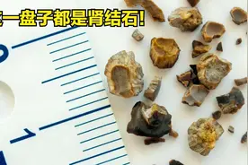 【手术展示】巧妙取出肾结石！视频封面