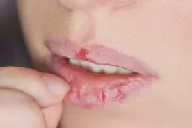 嘴唇干燥起皮不要撕，白糖加点它抹一抹，轻松搞定，方法真管用视频封面
