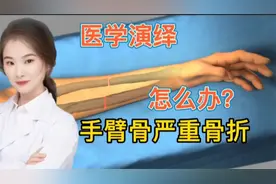 医学演绎 人体手臂骨头骨折骨裂 看医生如何进行治疗 手术固定视频封面