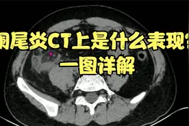 右下腹疼痛，怀疑阑尾炎，CT带你看看阑尾炎到什么程度！一图详解视频封面