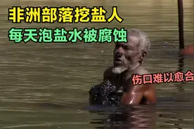 为了挣口饭每天泡盐水，伤口仅用塑料片覆盖，全身溃烂难以愈合！视频封面