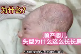 大揭秘 为什么顺产的新生儿大多数头型长长扁扁像“冬瓜”视频封面