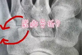 年轻女性，左脚扭伤，X光照片发现了什么常见骨折？听医生讲视频封面