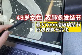 49岁女性双肺多发结节，最大7mm磨玻璃结节观察不变，要手术吗？视频封面