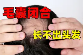 脱发多长时间毛囊会萎缩甚至闭合，毛囊闭合以后还能长出头发来吗