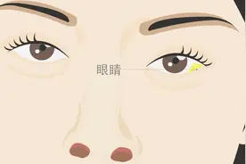 双眼皮手术后眼睛睁不上去是怎么回事？需要重新手术调整吗？视频封面