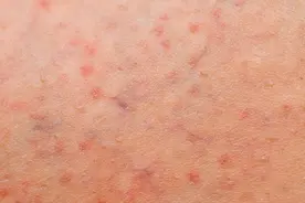 皮肤发生过敏，不处理，多久能自愈？视频封面