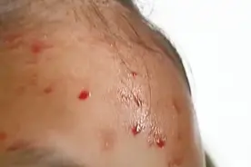 汗水有红色和蓝色 老人出现奇怪的蓝汗现象 原来是细菌在作祟！视频封面