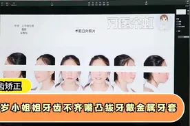 20多岁小姐姐牙齿不齐嘴凸怎么办？选择拔牙戴钢牙套矫正视频封面
