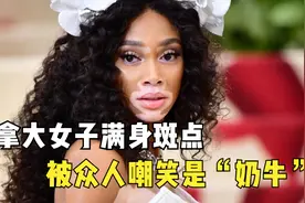 加拿大女子满身斑点，被众人嘲笑是“奶牛”，如今成为世界超模！视频封面