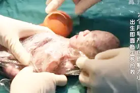 袖珍婴儿4：孩子终于出生了！但胳膊，却只有成年人的手指粗细！视频封面