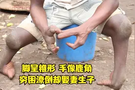 非洲男人天生四肢畸形，脚呈锥子状手像鹿角，穷困潦倒却娶妻生子视频封面