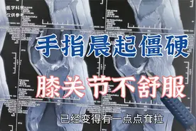患者手指晨起僵硬，膝盖不舒服，二者有没有关系？看肖医生怎么说视频封面