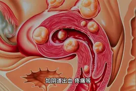 女性长了子宫息肉，需要手术吗？会不会影响怀孕？视频封面