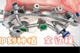 分享全口牙即刻种植当天拔牙当天种植手术全过程！视频封面