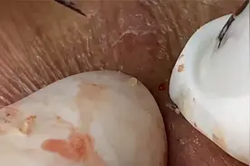 挤黑头，解压视频不喜误入，#强迫症 #极度舒适视频封面